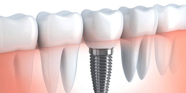 Dental Implants Brampton