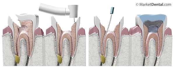 Illustration Depicting the Four Stages of a Root Canal Treatment for a Tooth